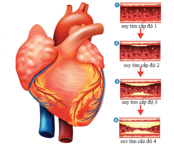 Bệnh lý tim mạch - 4 cấp độ của người suy tim