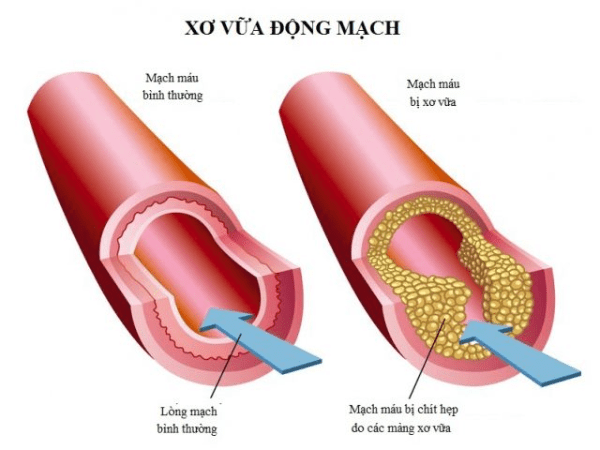 Xơ vữa động mạch - Bệnh xảy ra ở mọi lứa tuổi Xơ vữa động mạch - Bệnh xảy ra ở mọi lứa tuổi