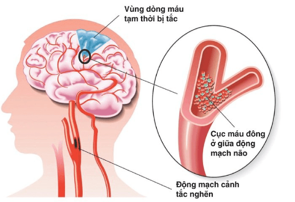 Huyết khối nằm ở não có thể gây đột quỵ