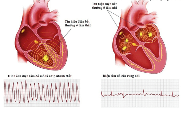 Rối loạn nhịp tim có nguy hiểm không ?